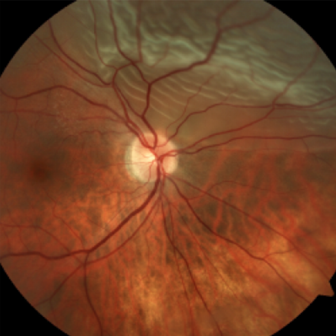 What is Myopia?